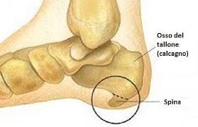 Sperone calcaneare- cause e cure